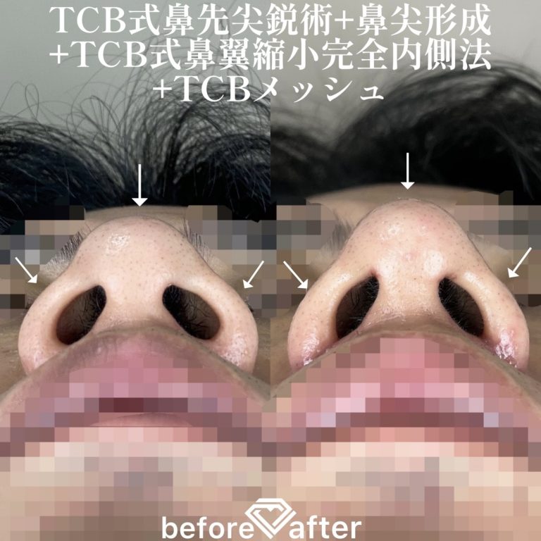 TCB式鼻先尖鋭術（だんご鼻解消）(担当医:TCB 医師)の症例写真2