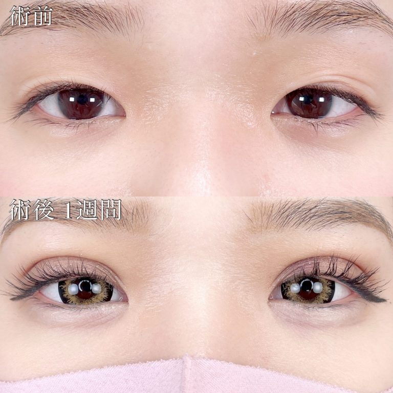二重埋没法(担当医:TCB 医師)の症例写真1