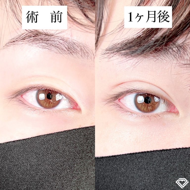 二重埋没法(担当医:TCB 医師)の症例写真1