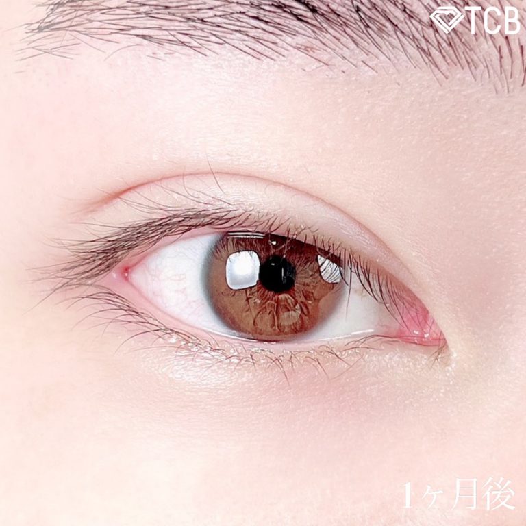 二重埋没法(担当医:TCB 医師)の症例写真2