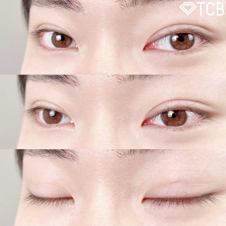 二重埋没法(担当医:TCB 医師)の症例写真3
