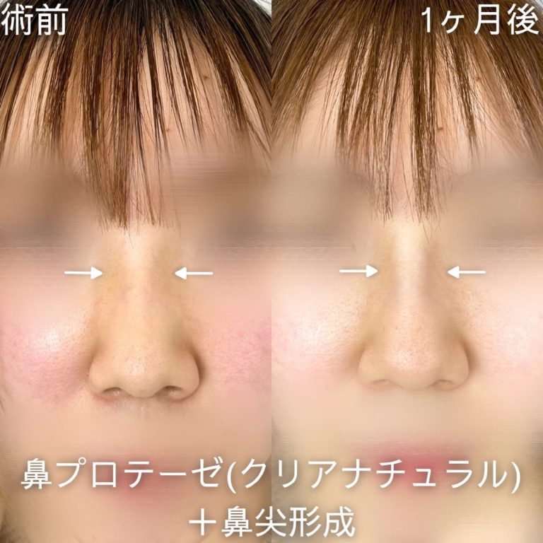 鼻プロテーゼ（隆鼻術）(担当医:山内 崇史 医師)の症例写真1