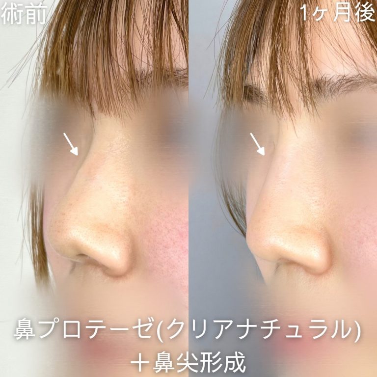 鼻プロテーゼ（隆鼻術）(担当医:山内 崇史 医師)の症例写真2