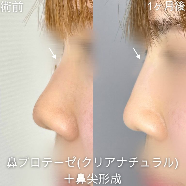 鼻プロテーゼ（隆鼻術）(担当医:山内 崇史 医師)の症例写真3