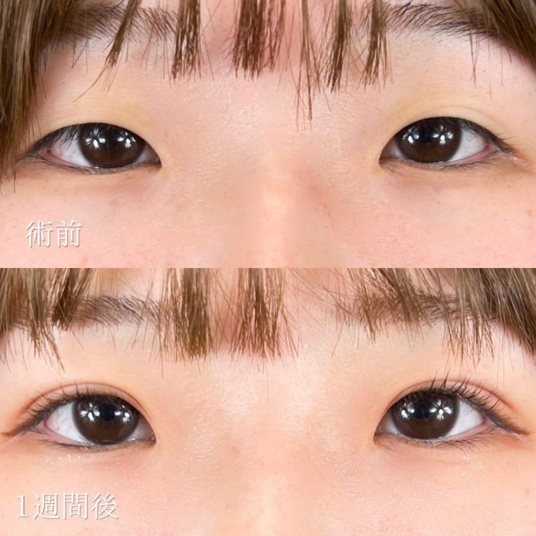 二重埋没法(担当医:TCB 医師)の症例写真1