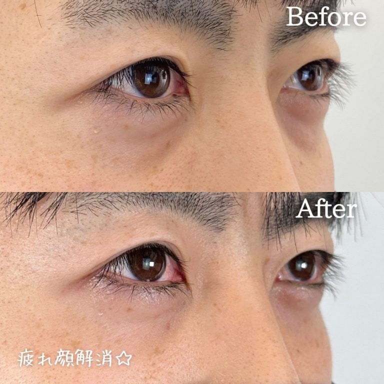 切らない目の下のクマ取り・目の下のたるみ（ふくらみ）取り(担当医:TCB 医師)の症例写真1