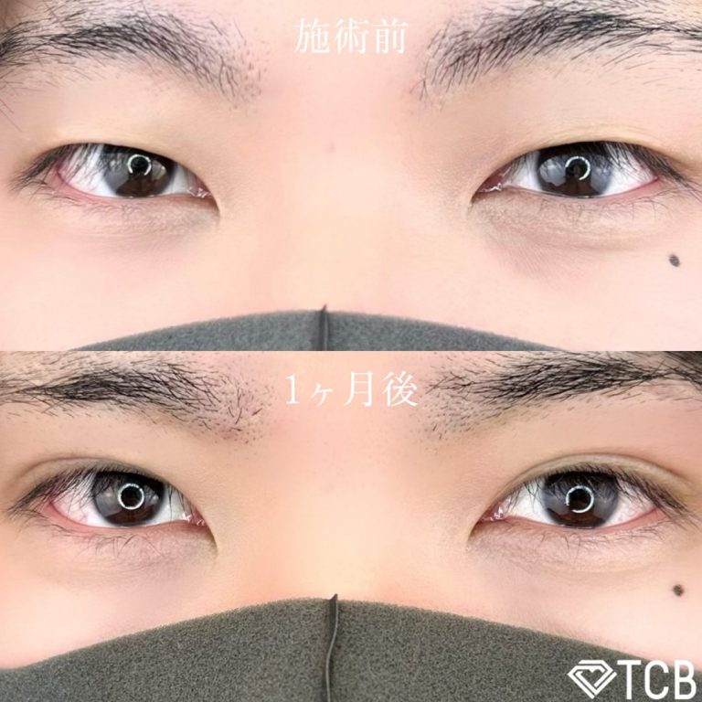 二重埋没法(担当医:津金 雄太 医師)の症例写真1