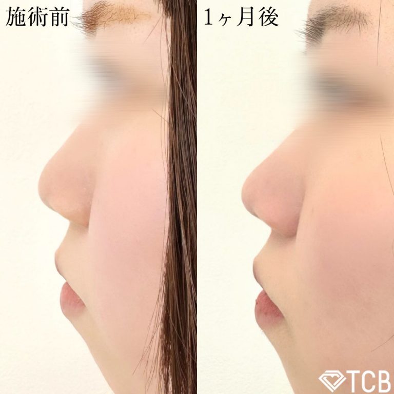 鼻尖形成完全閉鎖法（切らない鼻尖形成）(担当医:TCB 医師)の症例写真1