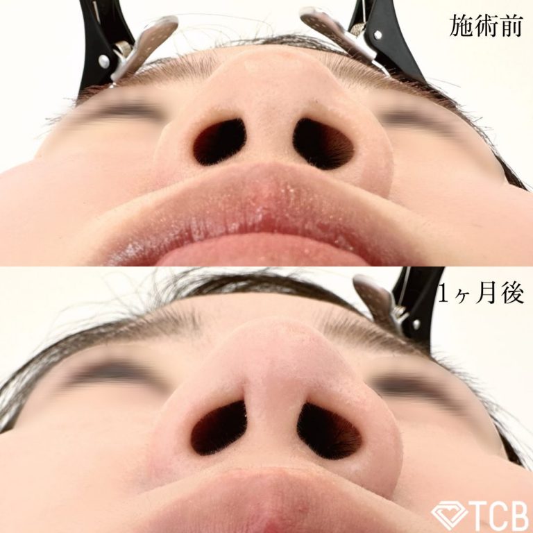 鼻尖形成完全閉鎖法（切らない鼻尖形成）(担当医:TCB 医師)の症例写真2