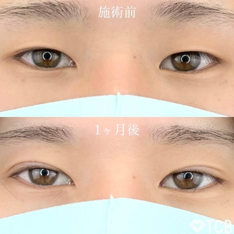 二重埋没法(担当医:TCB 医師)の症例写真1