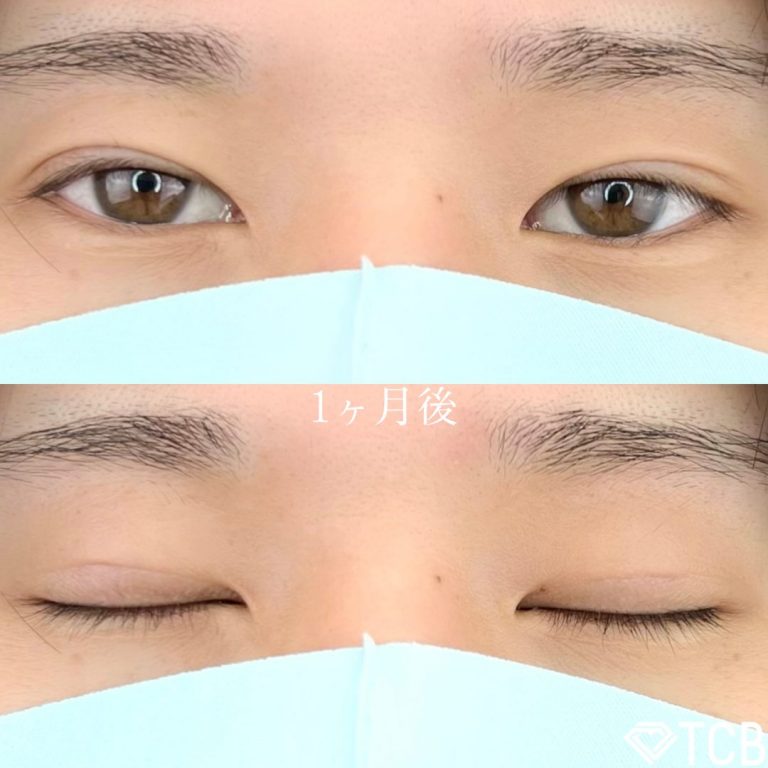 二重埋没法(担当医:TCB 医師)の症例写真2