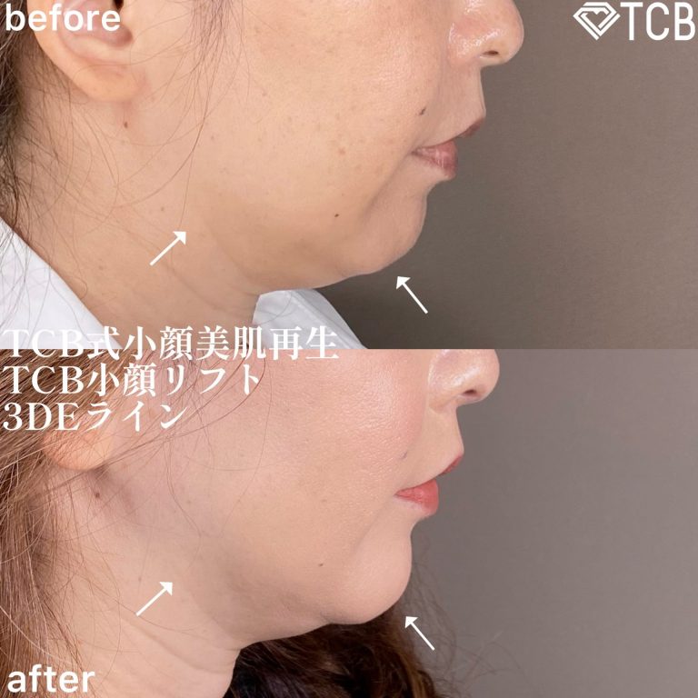 切らない顎形成 3D Eライン(担当医:森本 理一郎 医師)の症例写真2