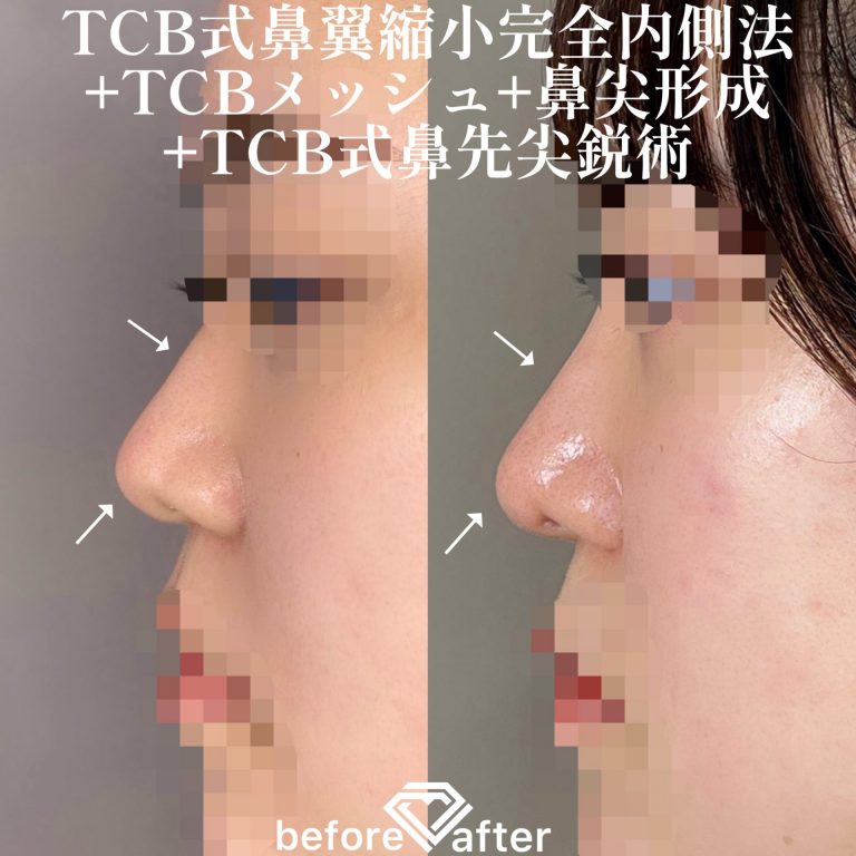 TCB式鼻翼縮小完全内側法(担当医:森本 理一郎 医師)の症例写真3