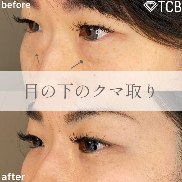 切らない目の下のクマ取り・目の下のたるみ（ふくらみ）取り(担当医:TCB 医師)の症例写真2