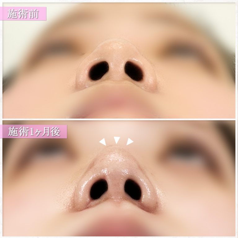 鼻尖形成(担当医:篠永 宏行 医師)の症例写真3