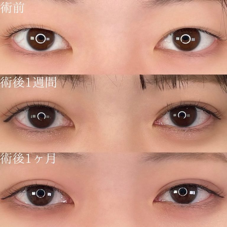二重埋没法(担当医:TCB 医師)の症例写真1