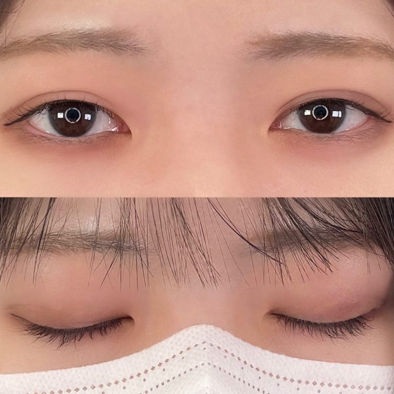 二重埋没法(担当医:TCB 医師)の症例写真2