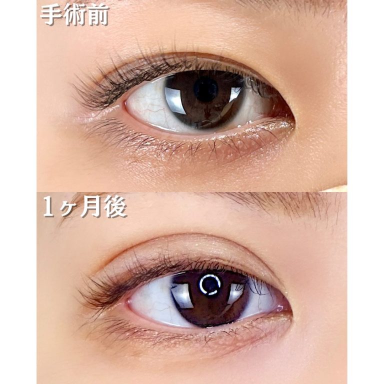 二重埋没法(担当医:TCB 医師)の症例写真1