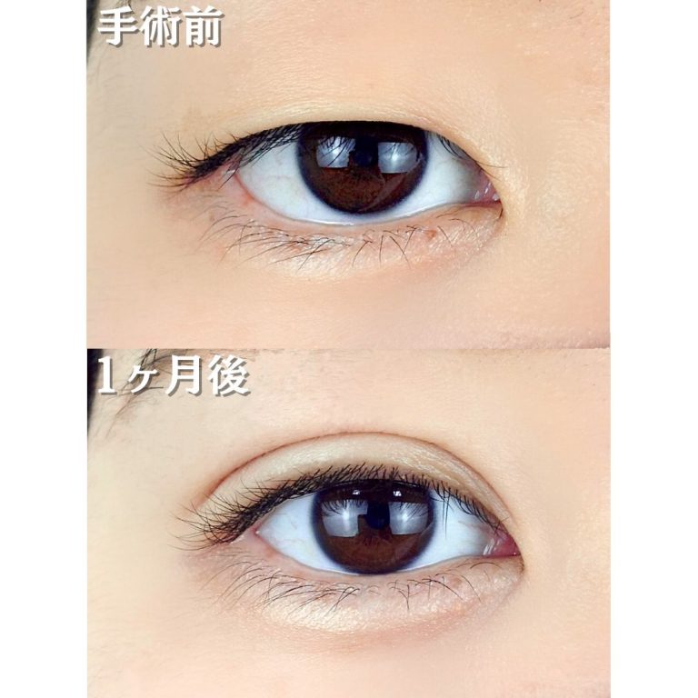 二重埋没法(担当医:TCB 医師)の症例写真1