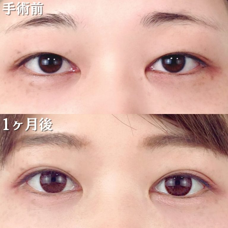 二重埋没法(担当医:TCB 医師)の症例写真1