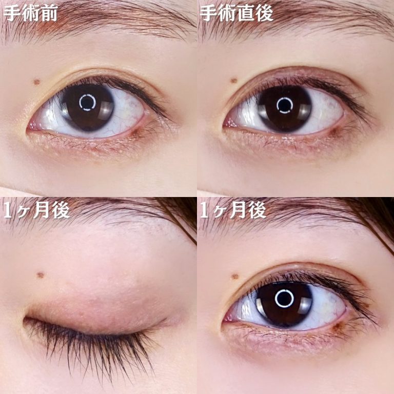二重埋没法(担当医:TCB 医師)の症例写真1