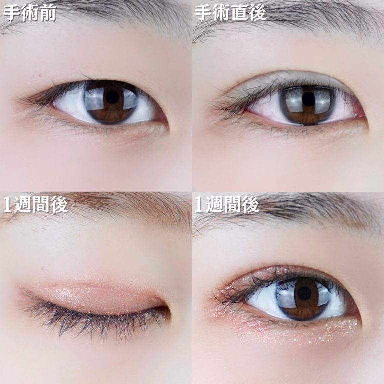 二重埋没法(担当医:TCB 医師)の症例写真1