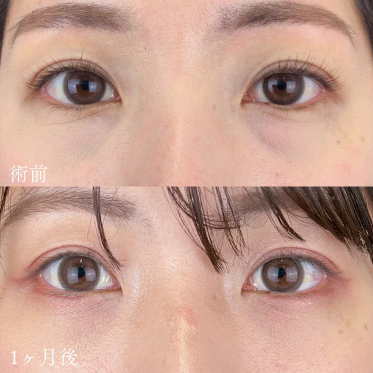 切らない目の下のクマ取り・目の下のたるみ（ふくらみ）取り(担当医:TCB 医師)の症例写真1