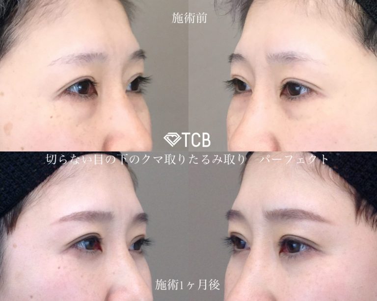 皮膚を切らない目の下のクマ取り・たるみ（ふくらみ）取り(担当医:TCB 医師)の症例写真1