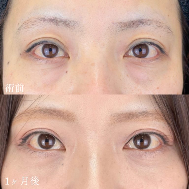 切らない目の下のクマ取り・目の下のたるみ（ふくらみ）取り(担当医:TCB 医師)の症例写真1