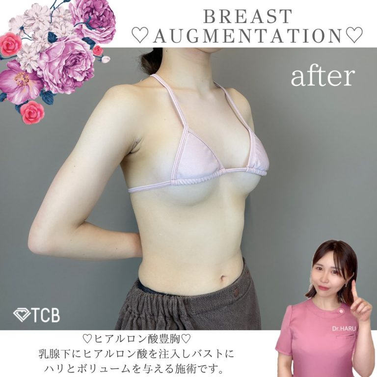 TCB式ヒアルロン酸豊胸(担当医:池田 悠 医師)の症例写真1