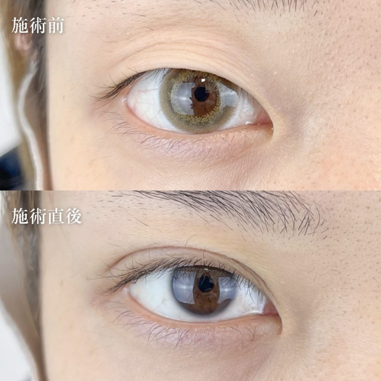 二重埋没法(担当医:TCB 医師)の症例写真1