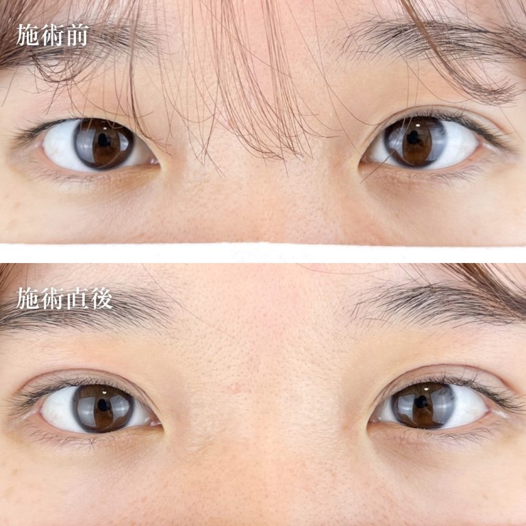 二重埋没法(担当医:TCB 医師)の症例写真1
