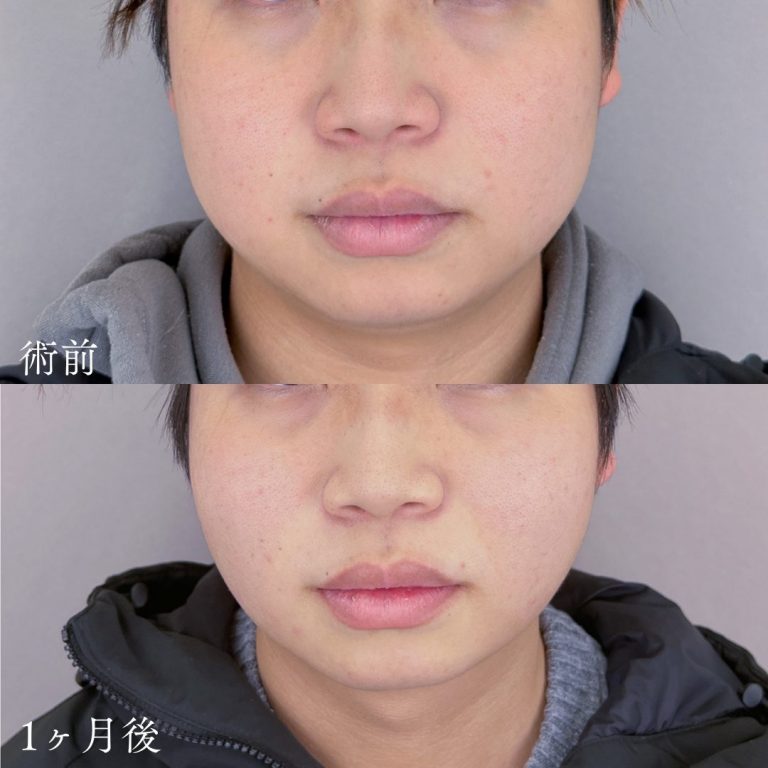 小顔美肌再生（リフトアップ）(担当医:TCB 医師)の症例写真1