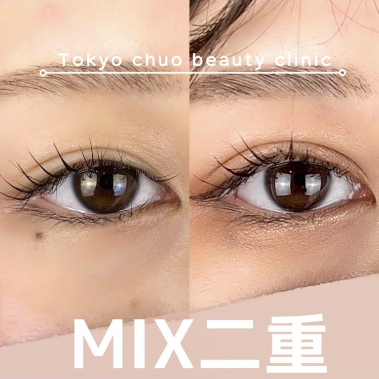 二重埋没法(担当医:TCB 医師)の症例写真1