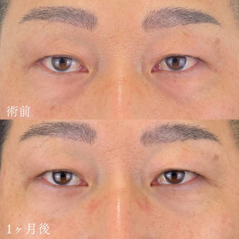 切らない目の下のクマ取り・目の下のたるみ（ふくらみ）取り(担当医:TCB 医師)の症例写真1
