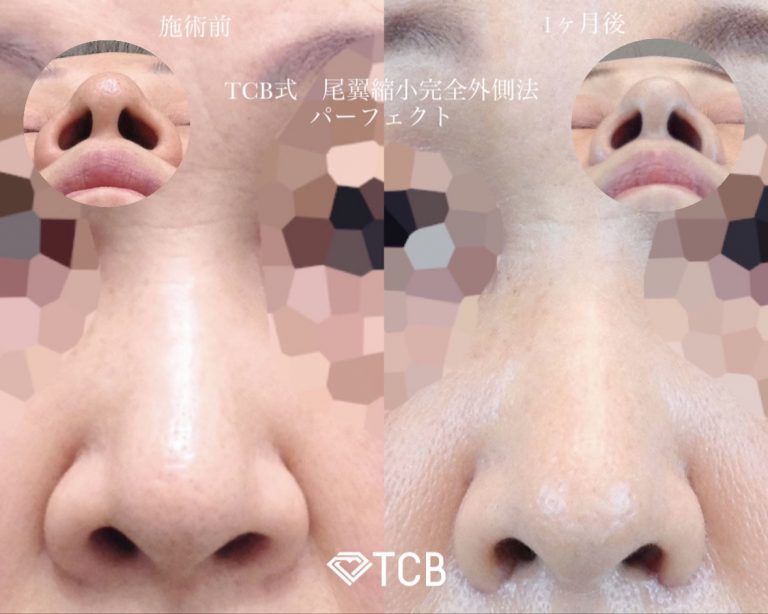 TCB式鼻翼縮小完全内側法(担当医:寺西 宏王 医師)の症例写真1