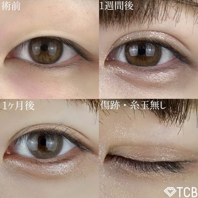 二重埋没法(担当医:TCB 医師)の症例写真2
