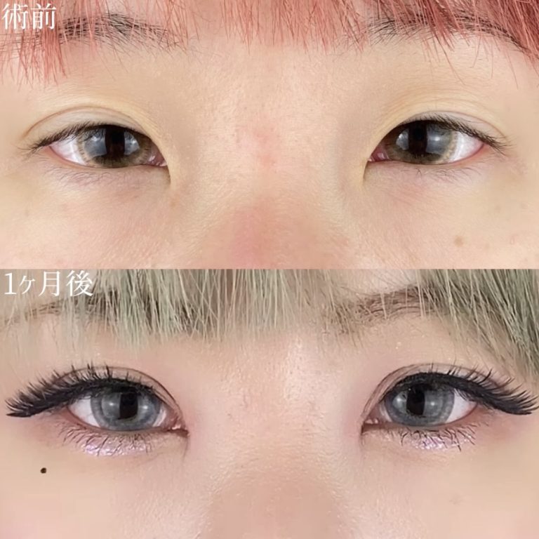 二重埋没法(担当医:TCB 医師)の症例写真1