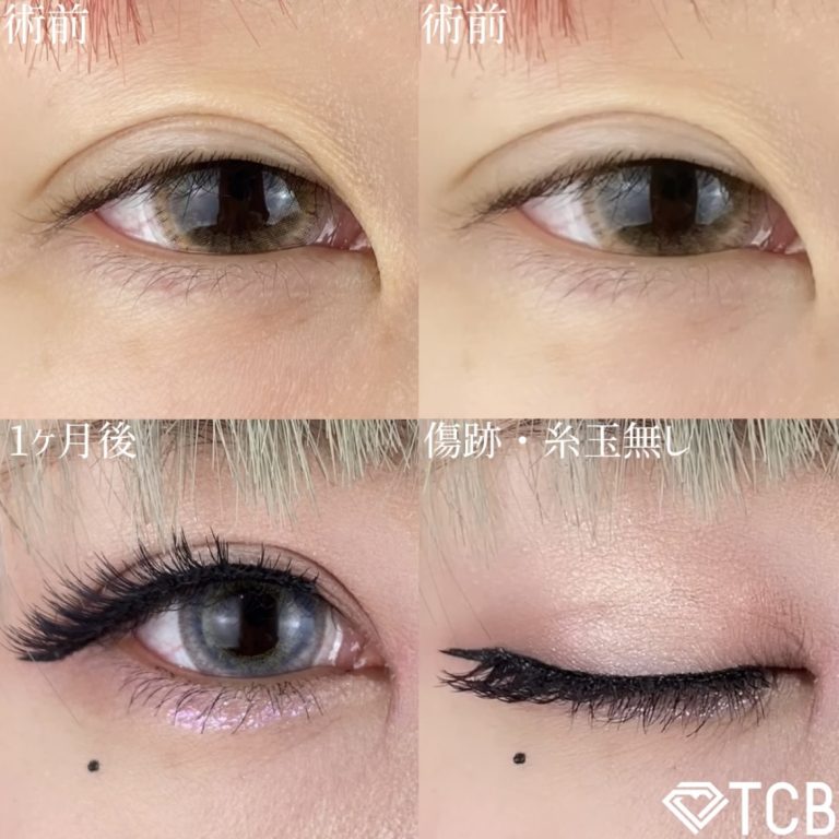 二重埋没法(担当医:TCB 医師)の症例写真2