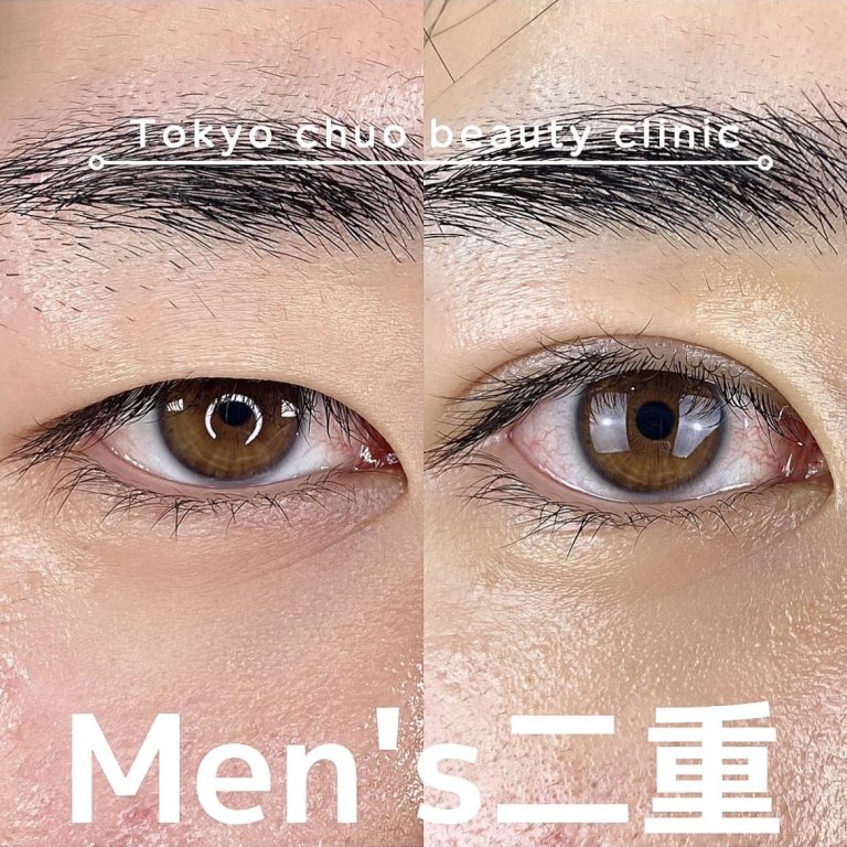 二重埋没法(担当医:TCB 医師)の症例写真3