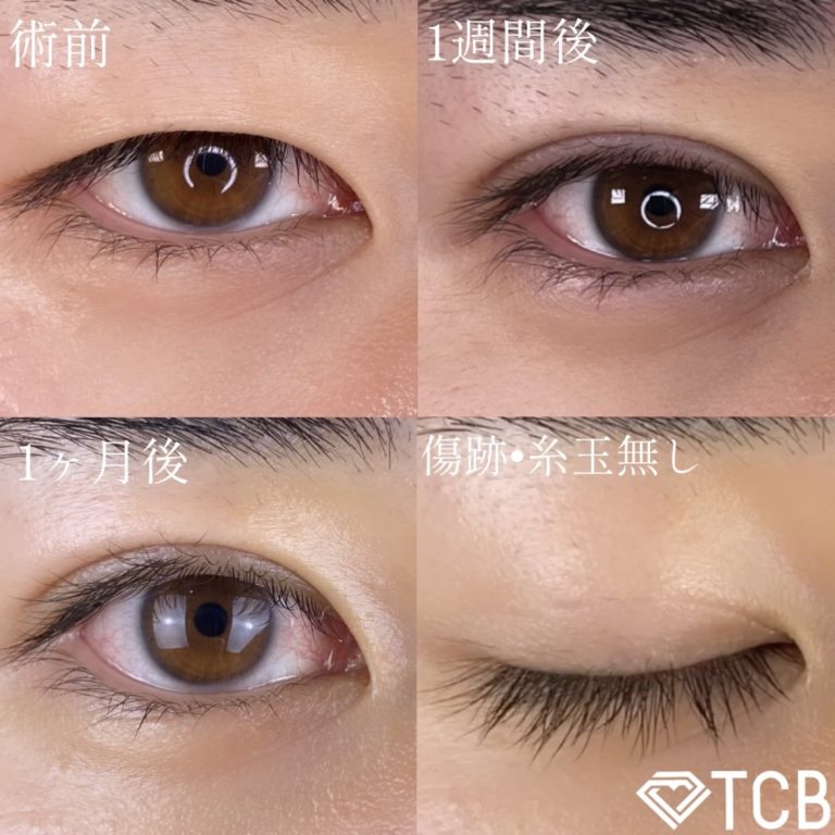 二重埋没法(担当医:TCB 医師)の症例写真1