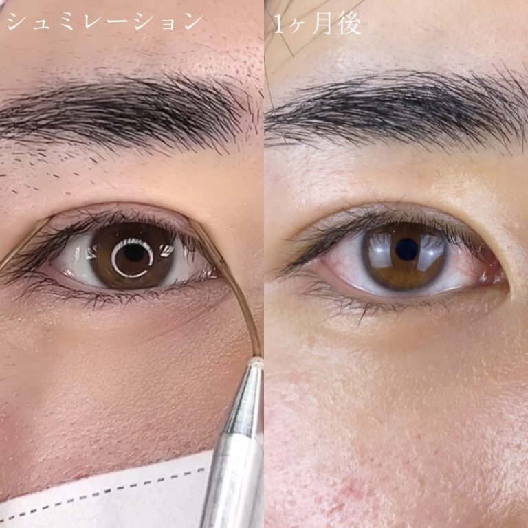 二重埋没法(担当医:TCB 医師)の症例写真2