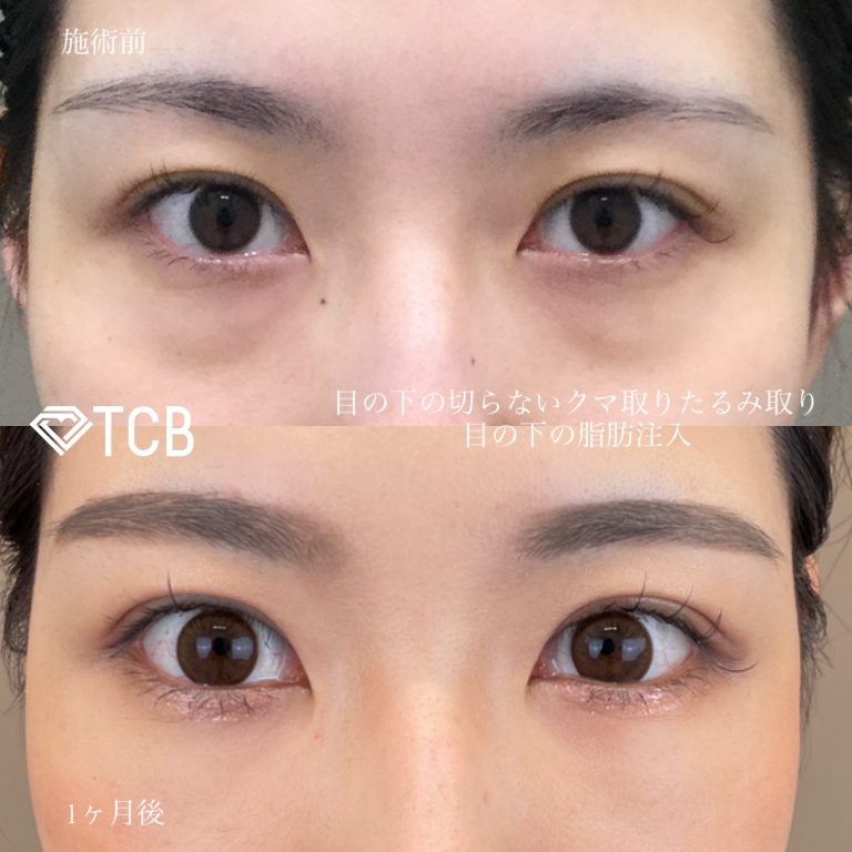 切らない目の下のクマ取り・目の下のたるみ（ふくらみ）取り(担当医:寺西 宏王 医師)の症例写真1