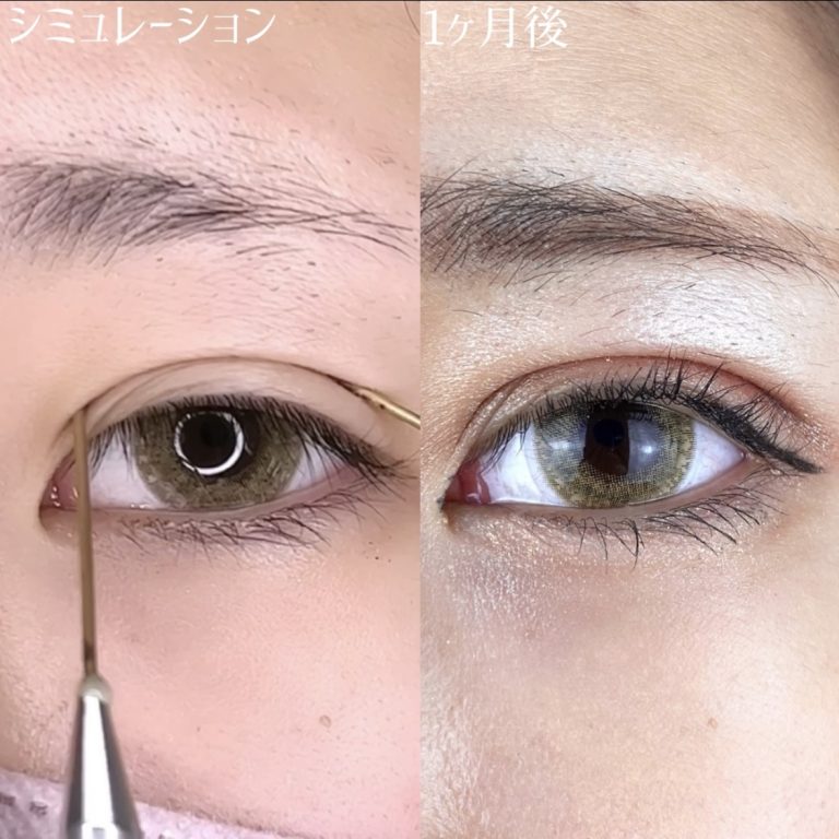 二重埋没法(担当医:TCB 医師)の症例写真3