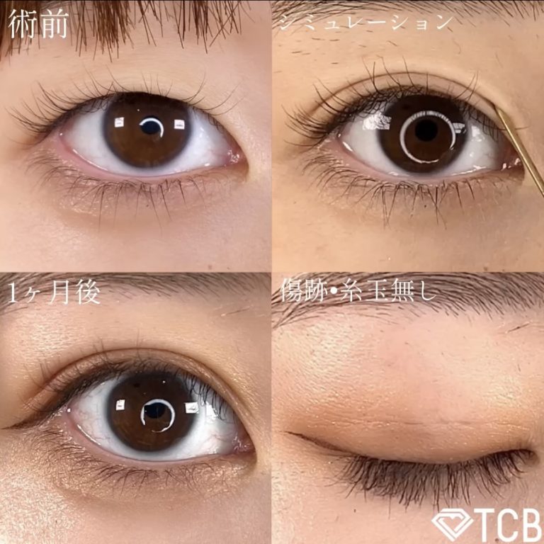 二重埋没法(担当医:TCB 医師)の症例写真1