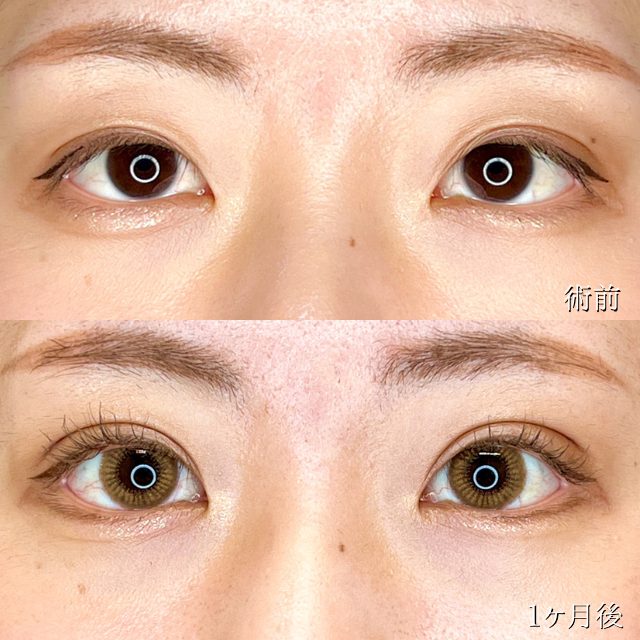 二重埋没法(担当医:TCB 医師)の症例写真1