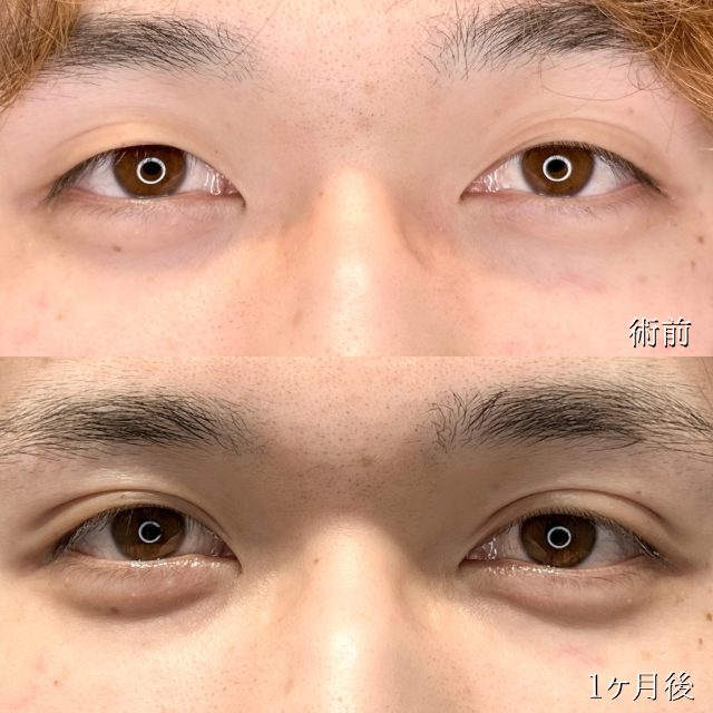 二重埋没法(担当医:TCB 医師)の症例写真1