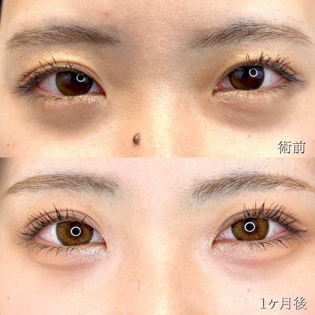 二重埋没法(担当医:TCB 医師)の症例写真1