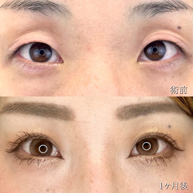 二重埋没法(担当医:TCB 医師)の症例写真1