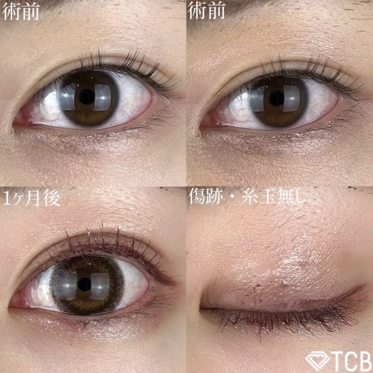 二重埋没法(担当医:TCB 医師)の症例写真1